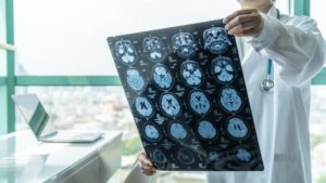Types of Traumatic Brain Injury Cases We Handle