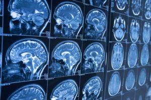 Why Do I Need an Experienced Personal Injury Lawyer to Help With My Brain Injury Claim in Fort Lauderdale?