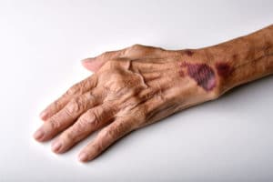 Why Should I Call a Personal Injury Lawyer to Help With My Boca Raton Soft Tissue Injury Claim?