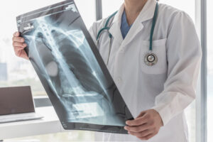 How Our Boca Raton Medical Malpractice Lawyer Can Help With a Pulmonary Embolism Claim 