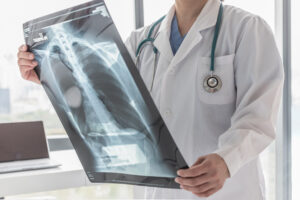How Our Boca Raton Medical Malpractice Lawyer Can Help With a Pulmonary Embolism Claim